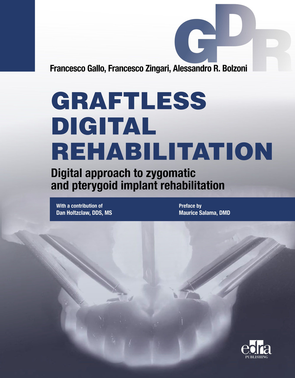 Graftless digital rehabilitation, gdr. Digital approach to zygomatic and pterygoid implant rehabilitation. Con QR Code