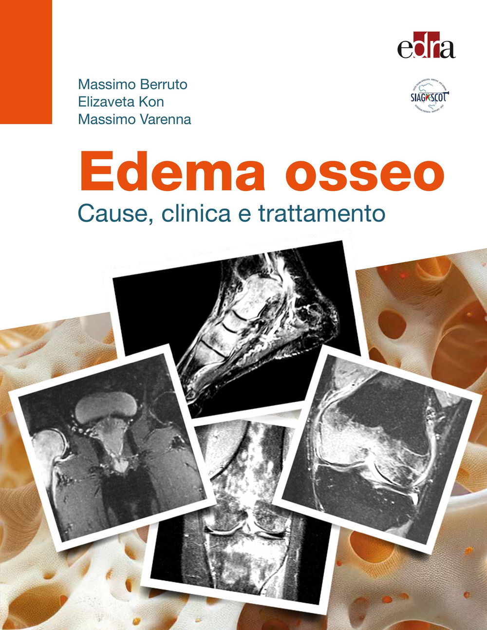 Edema osseo. Cause, clinica e trattamento