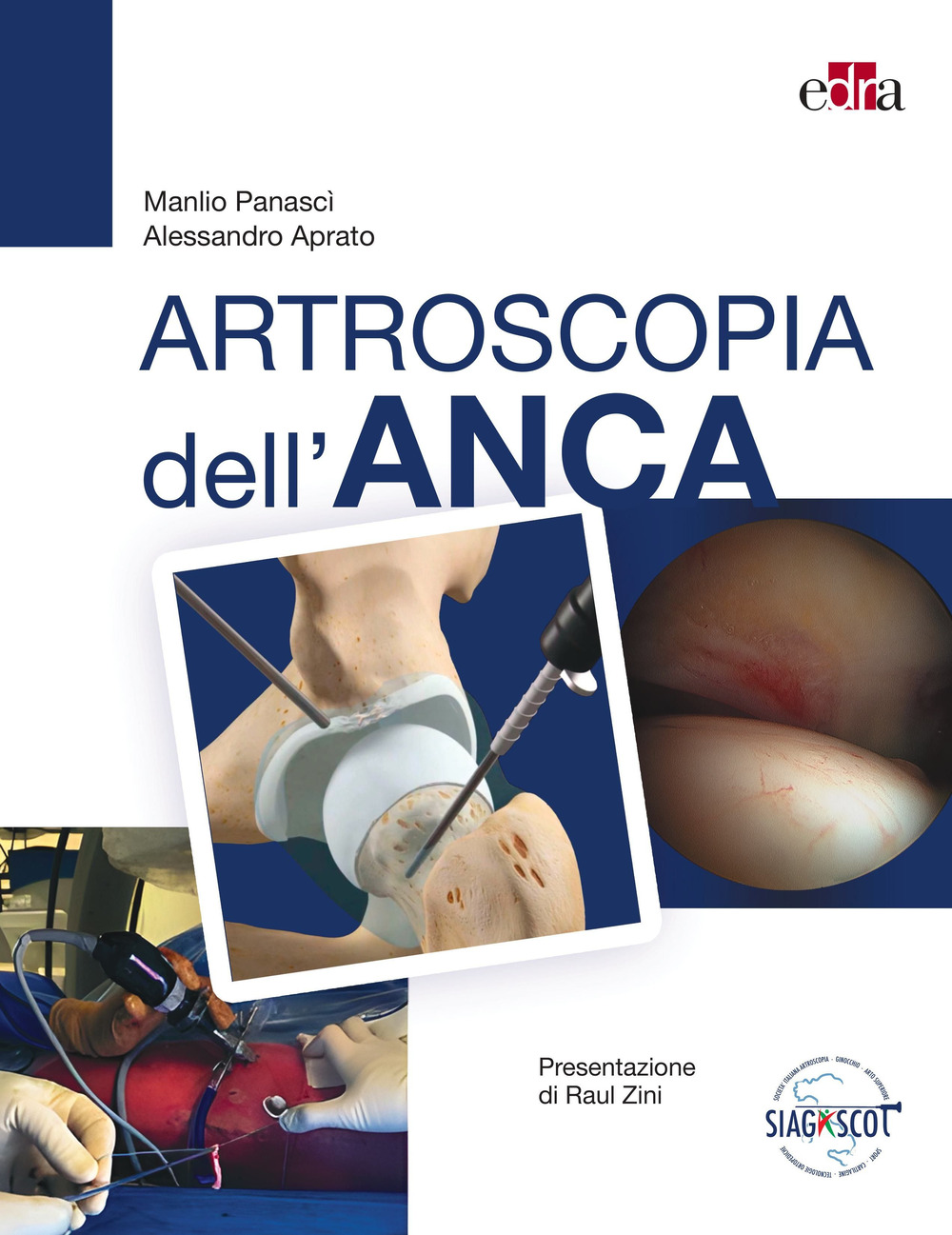 Artroscopia dell'anca