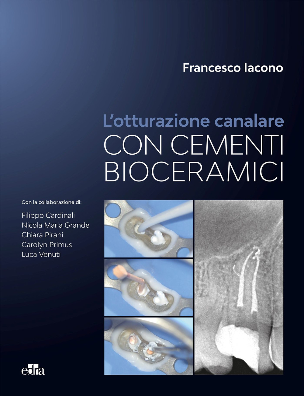 L'otturazione canalare con i cementi bioceramici