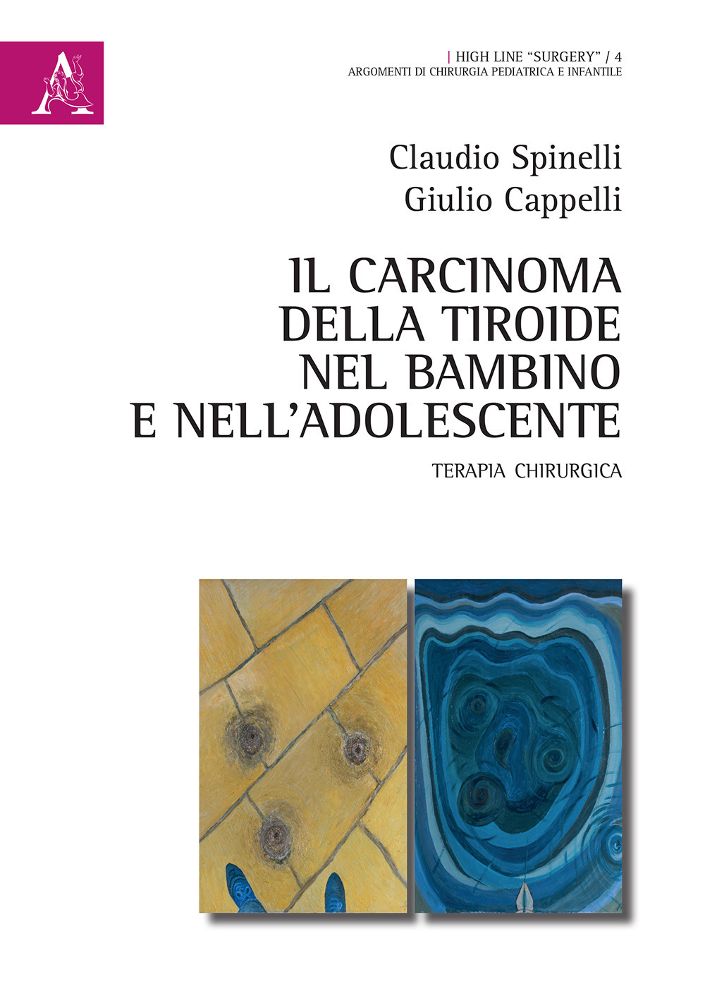 Il carcinoma della tiroide nel bambino e nell'adolescente. Terapia chirurgica