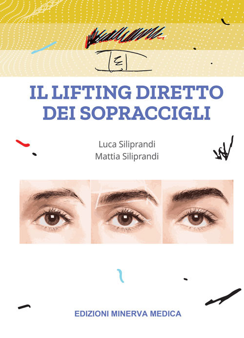 Il lifting diretto dei sopraccigli