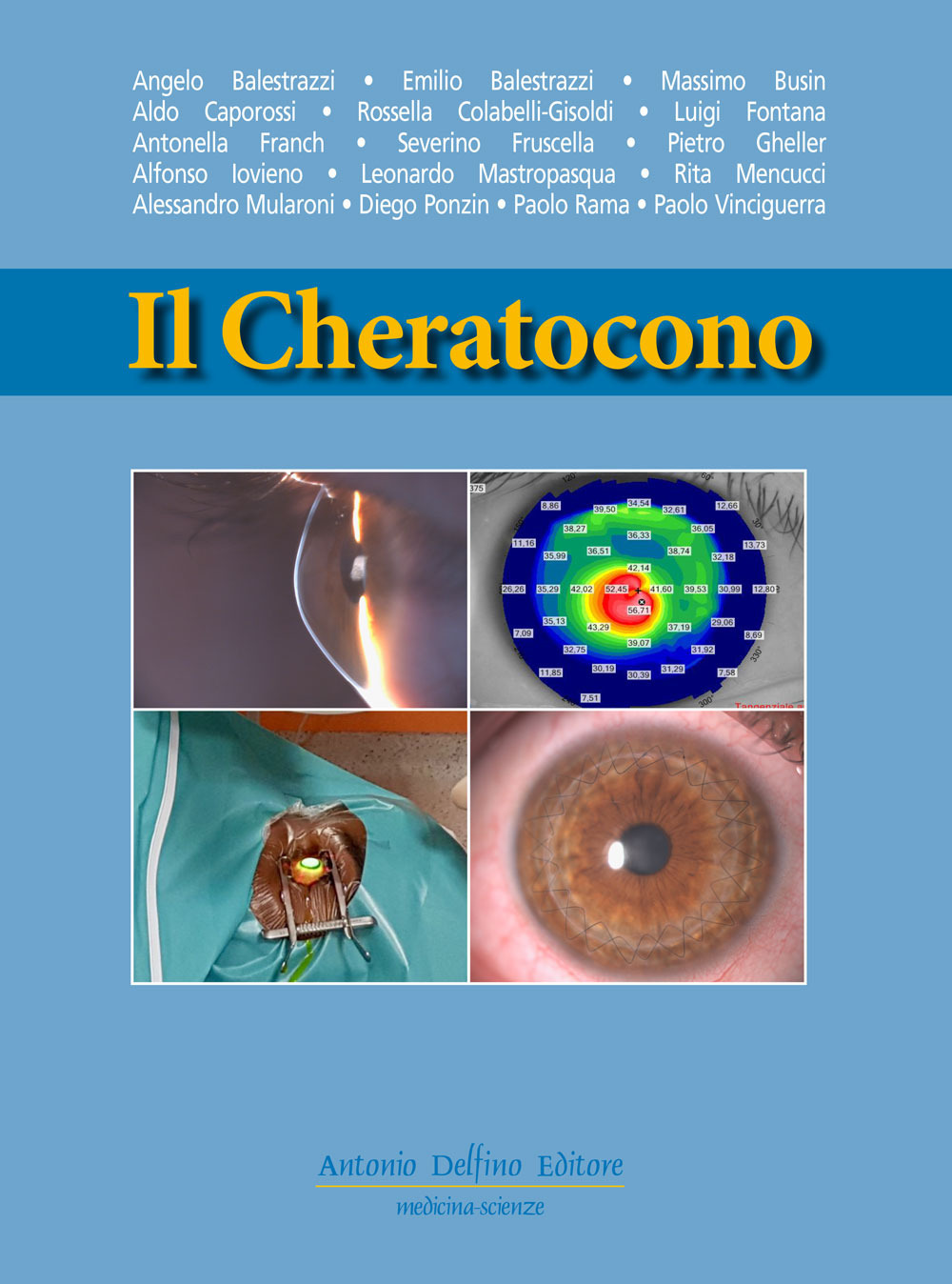 Il cheratocono