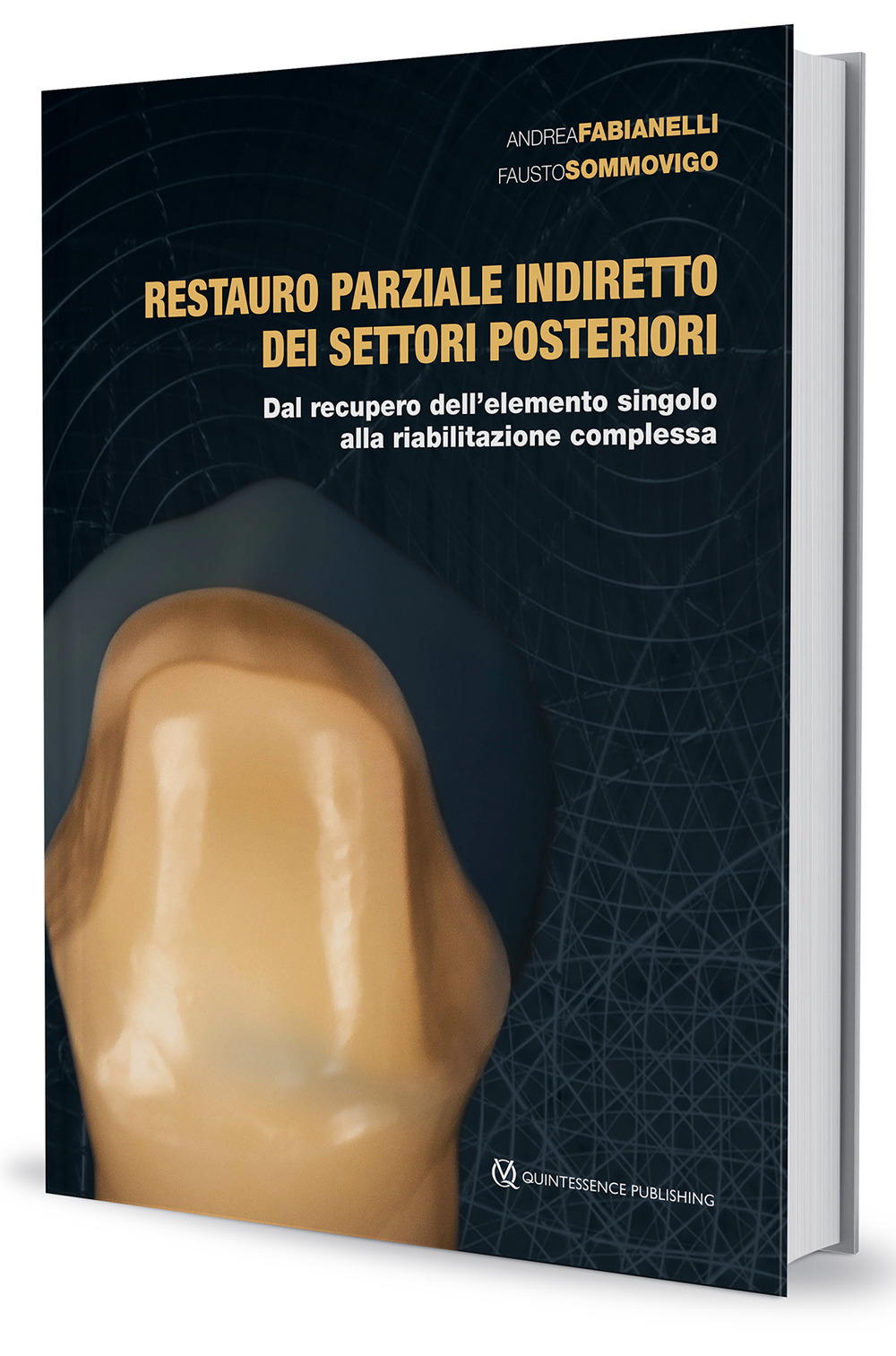 Restauro parziale indiretto dei settori posteriori. Dal recupero dell'elemento singolo alla riabilitazione complessa