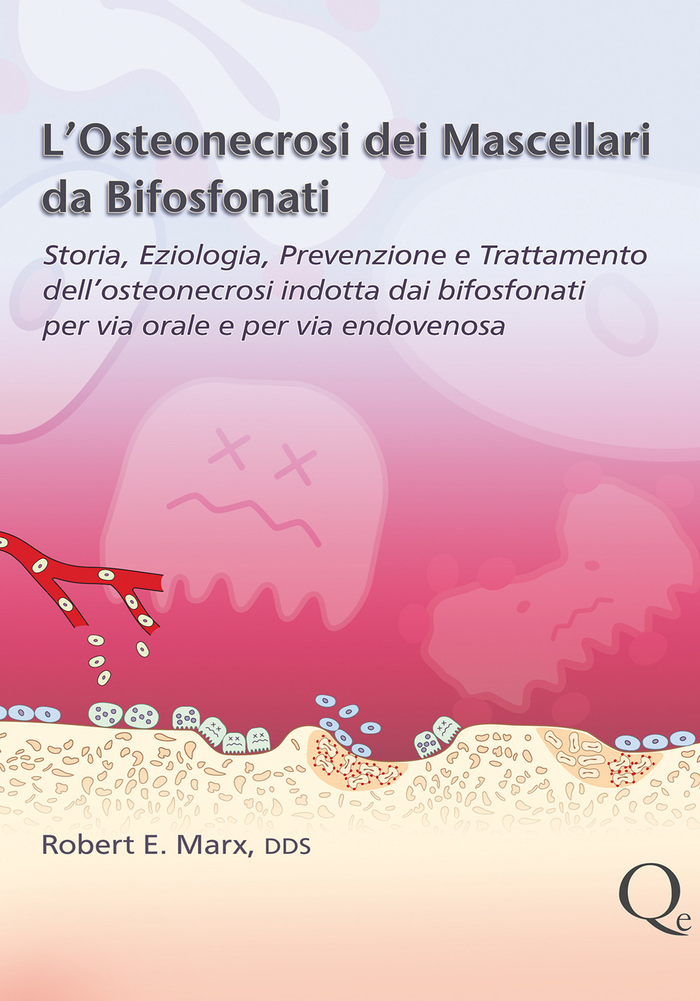 L'osteonecrosi dei mascellari da bifosfonati