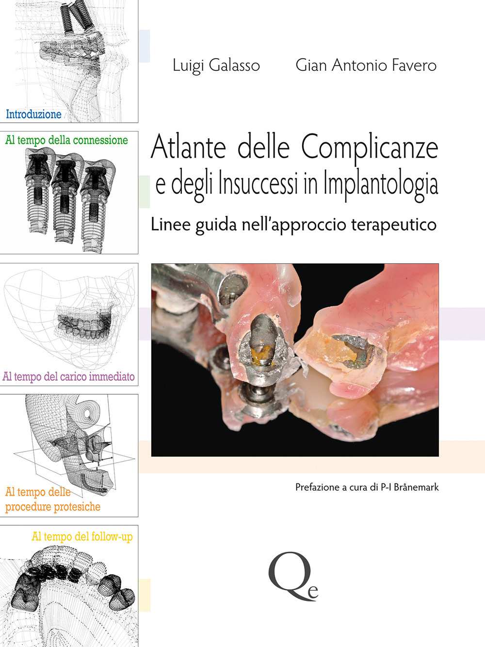 Atlante delle complicanze e degli insuccessi in implantologia. Linee guida nell'approccio terapeutico