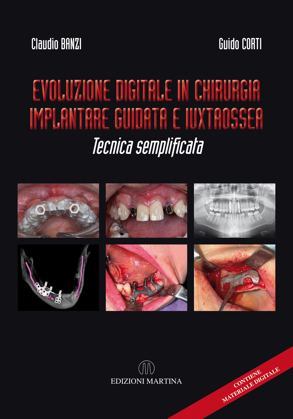 Evoluzione digitale in chirurgia implantare guidata e iuxtaossea. Tecnica semplificata. Ediz. italiana e inglese. Con QR Code