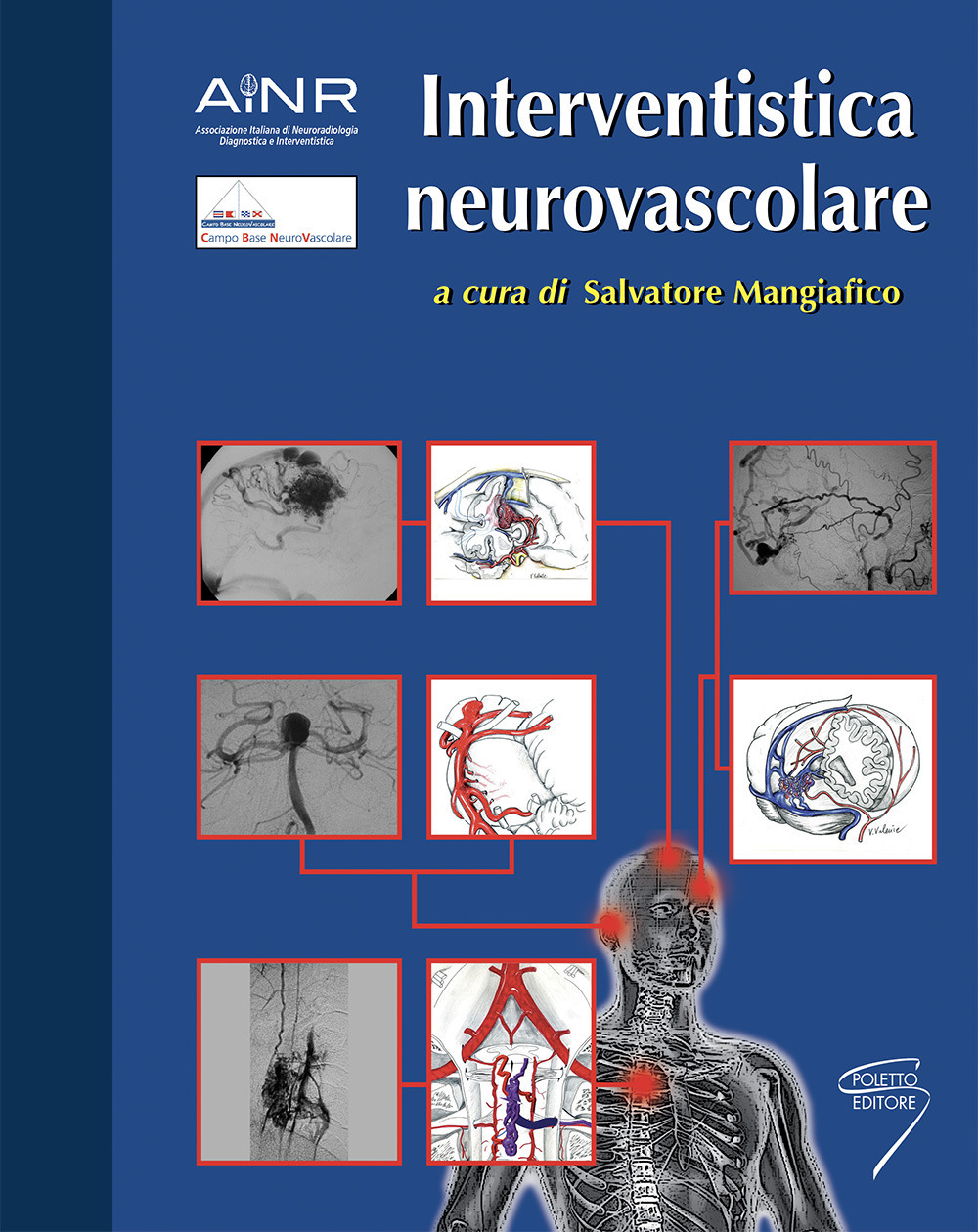 Interventistica neurovascolare