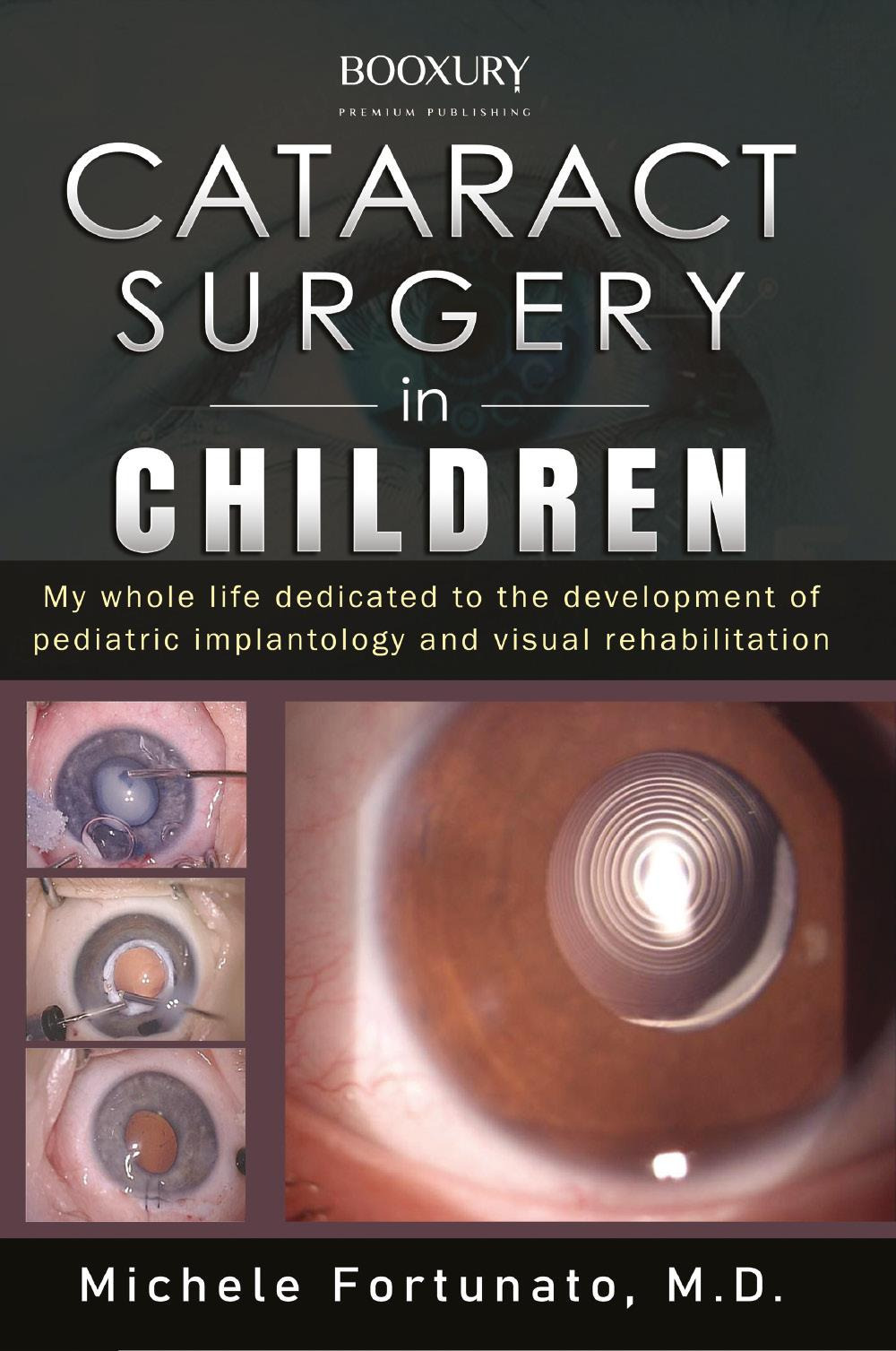 Cataract surgery in children