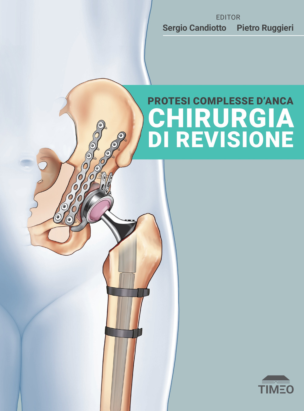 Protesi complesse d'anca. Chirurgia di revisione. Ediz. illustrata