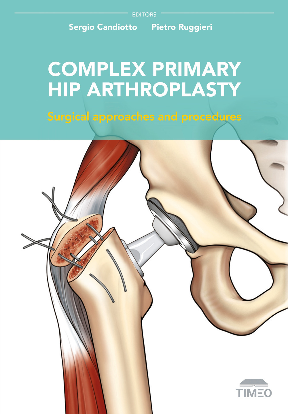 Complex primary hip arthroplasty. Surgical approaches and procedures